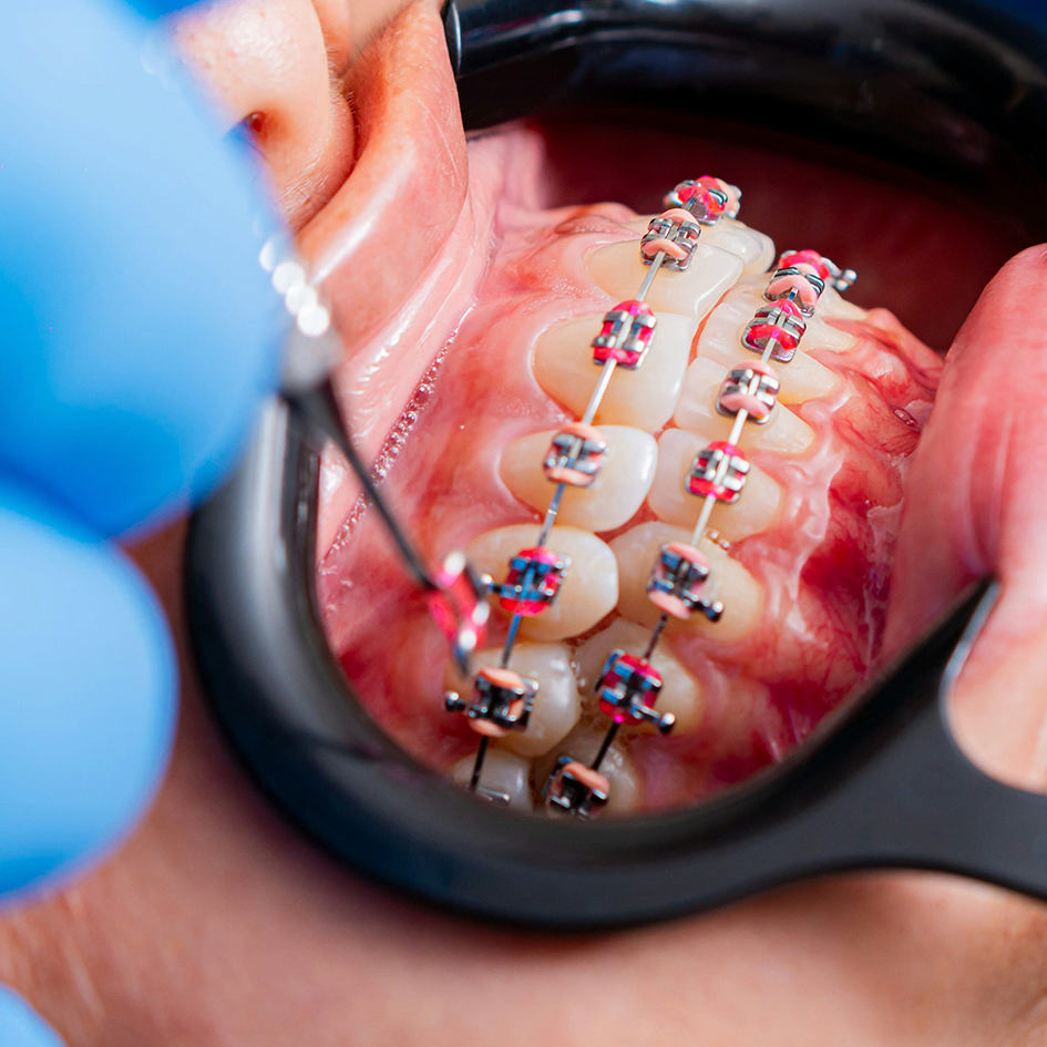 Orthodontie dento-faciale
